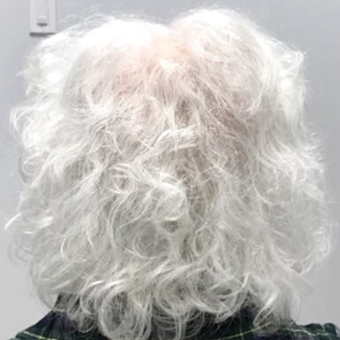 Hair restoration patient after photo