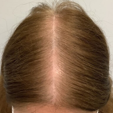 Hair restoration patient after photo