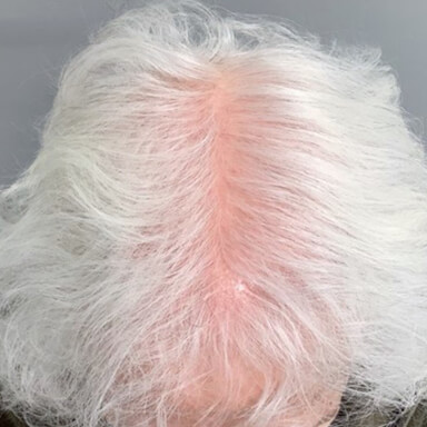 Hair restoration patient before photo