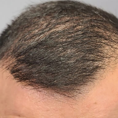 Hair restoration patient before photo